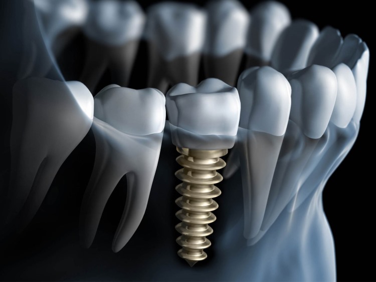 Reabilitação sobre implantes