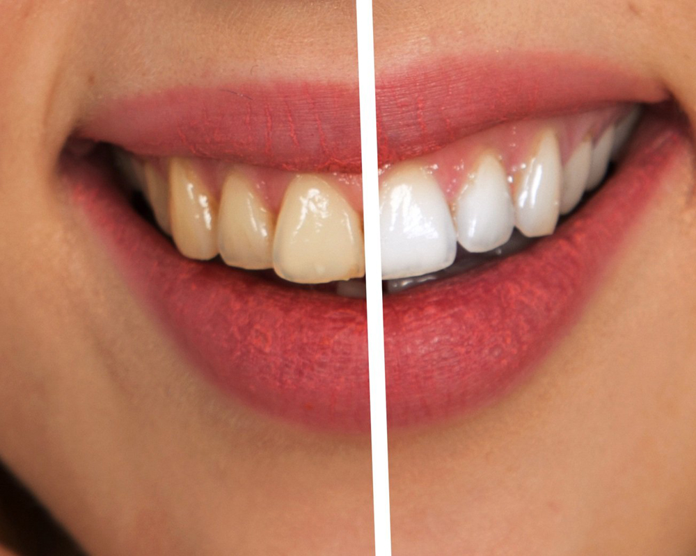Branqueamento dentário