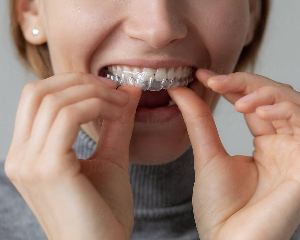 Harmonização do sorriso com alinhadores invisíveis