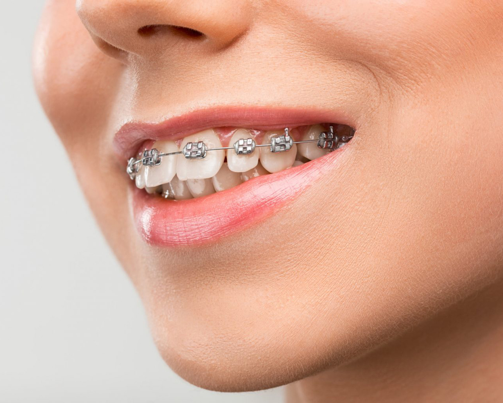 Aparelhos metálicos tradicionais<br/> - eficazes e ideais para casos mais complexos