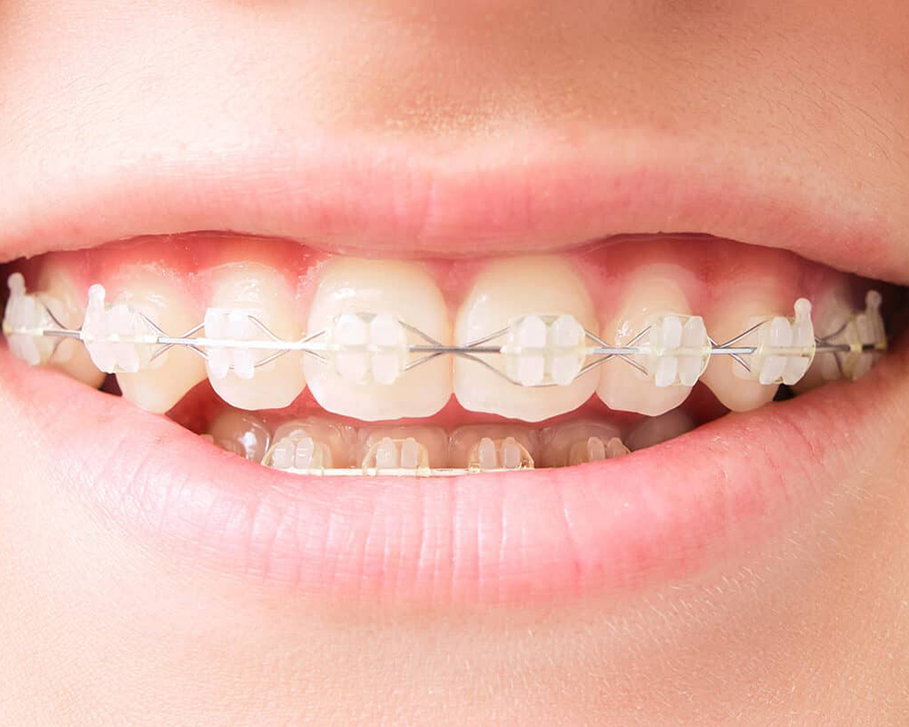 Aparelhos estéticos<br/> - mais discretos, mantendo a eficácia