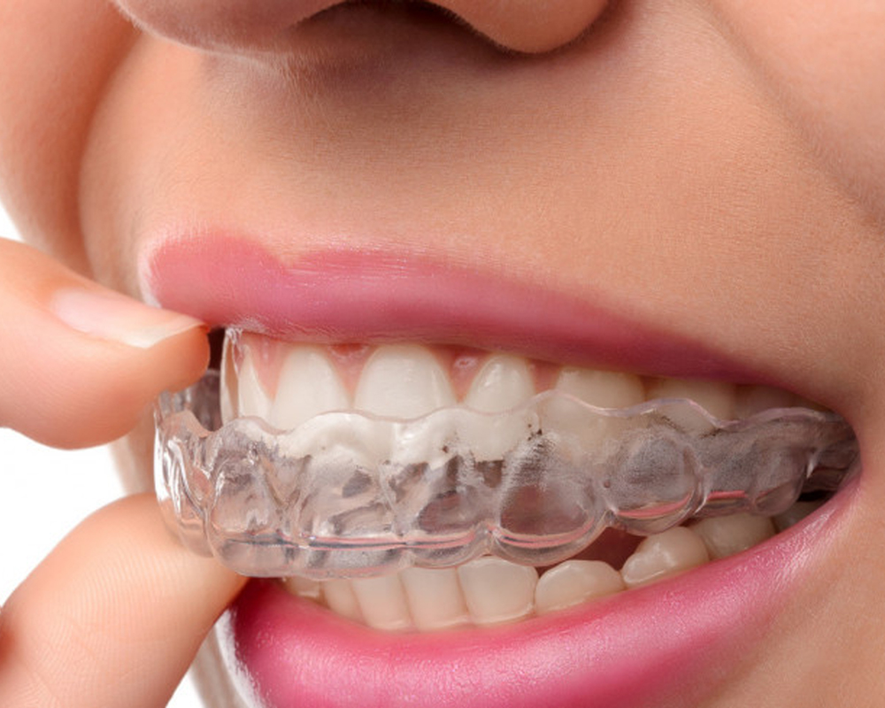 Alinhadores invisíveis (Invisalign®)<br/> - removíveis, quase impercetíveis e altamente confortáveis, perfeitos para quem procura discrição no tratamento.